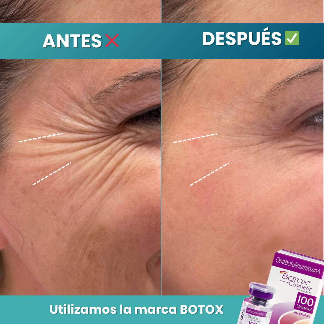 Botox Facial 2 Zonas | Corrección de Líneas de Expresión