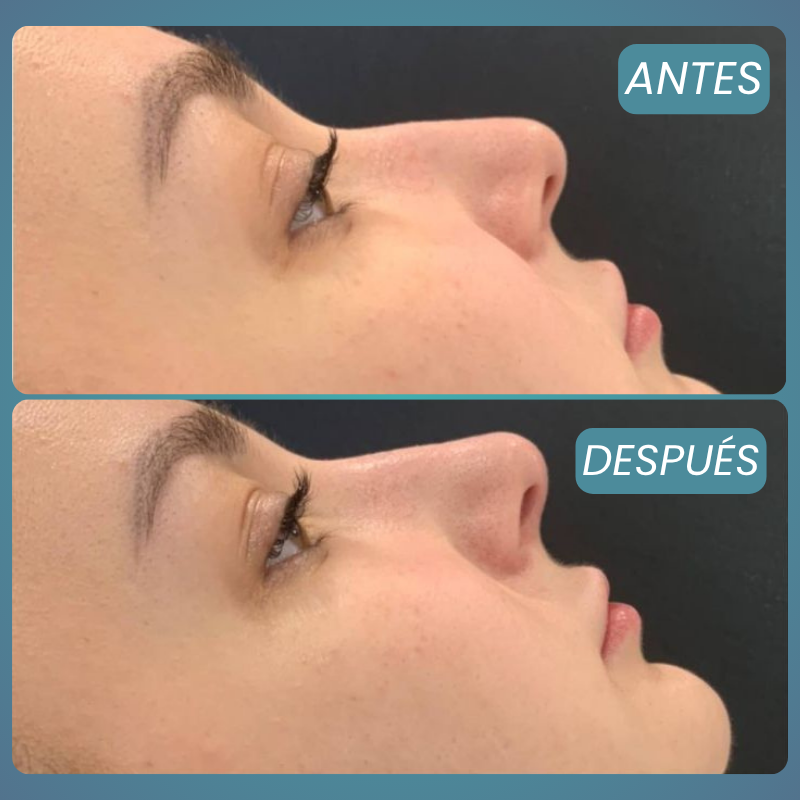 Rinomodelación – 1 Zona (Ácido Hialurónico)