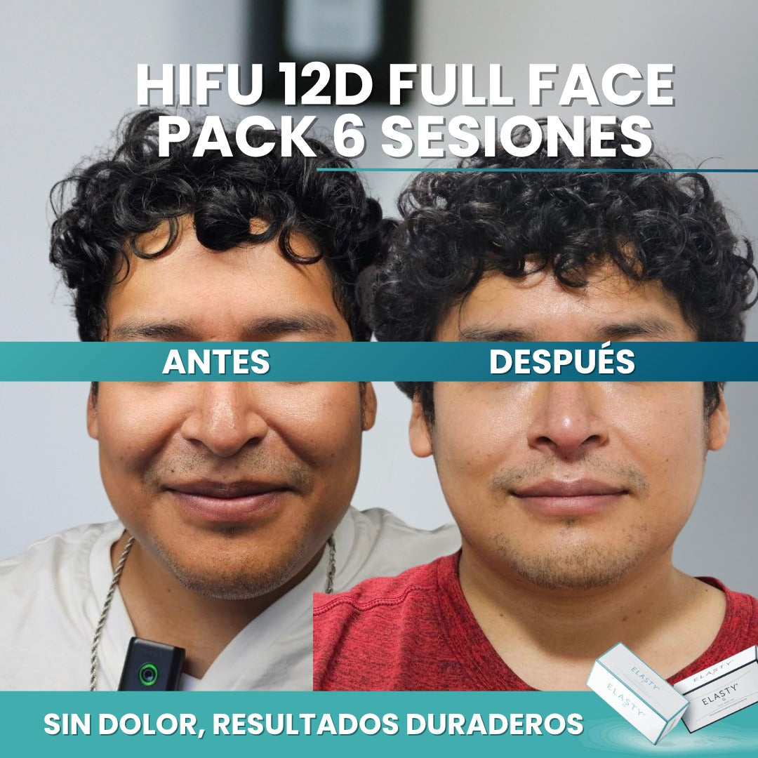 HIFU 12D Full Face | Rejuvenecimiento Facial Sin Cirugía