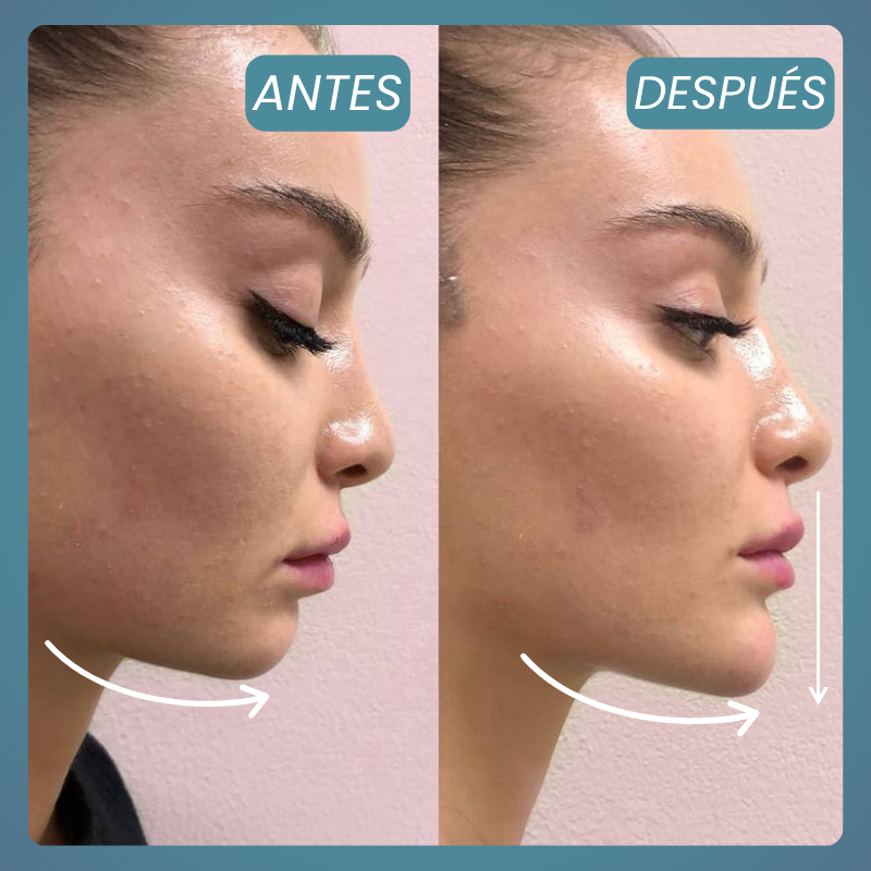 Definición y Armonización del Mentón – 1 Zona (Ácido Hialurónico)