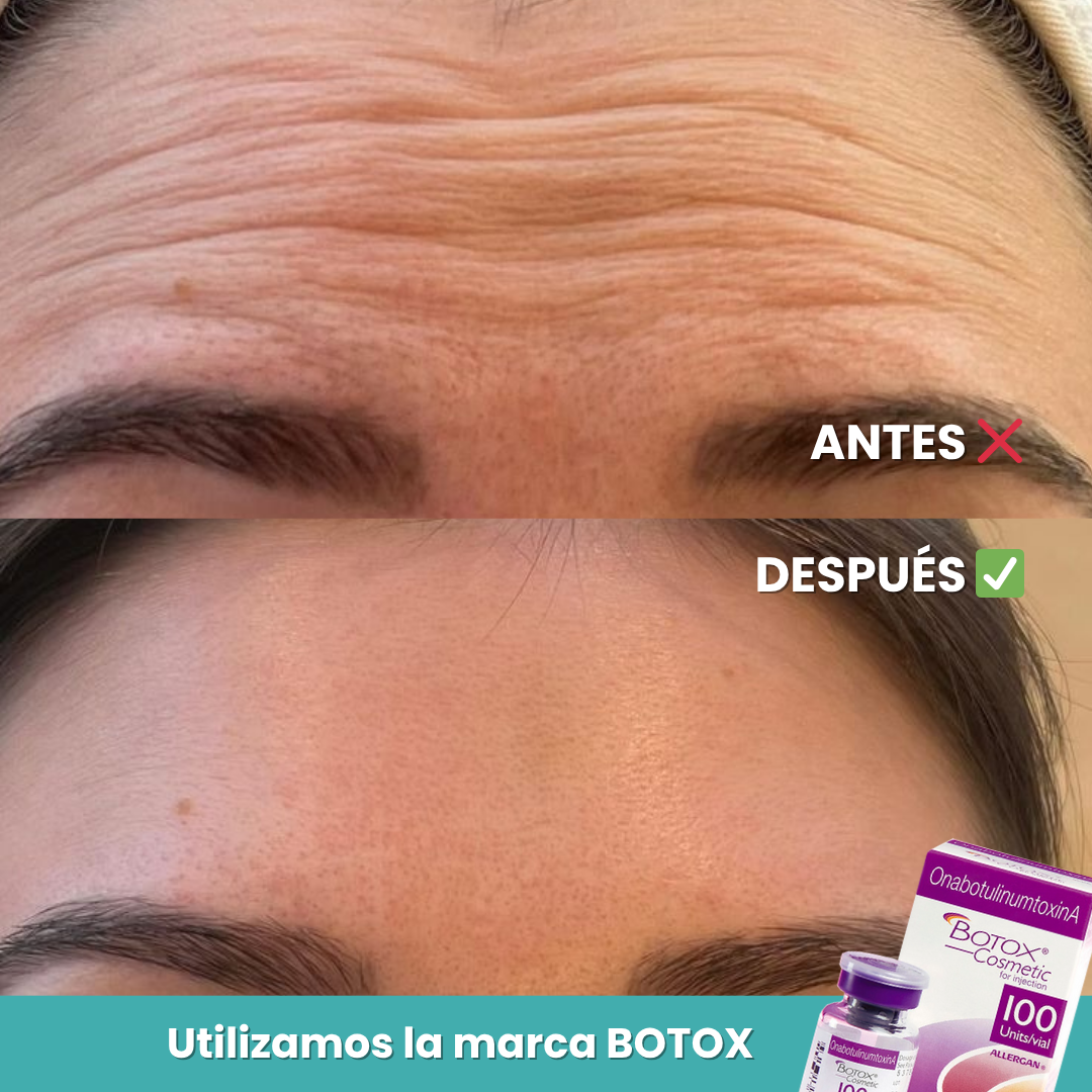 Botox Facial 1 Zona | Corrección de Líneas de Expresión