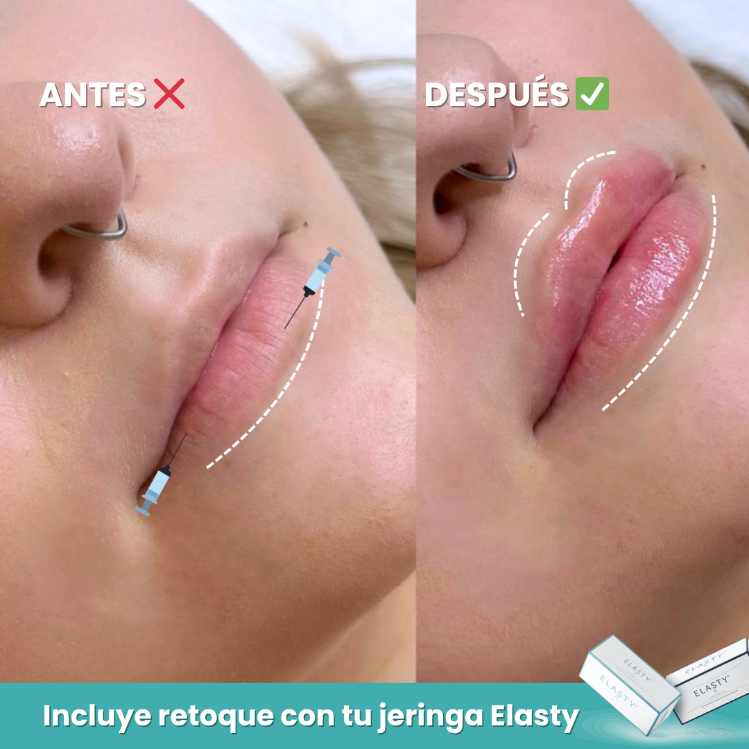 Aumento Labial Natural con Ácido Hialurónico