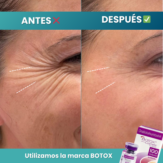 Botox Facial 1 Zona | Corrección de Líneas de Expresión