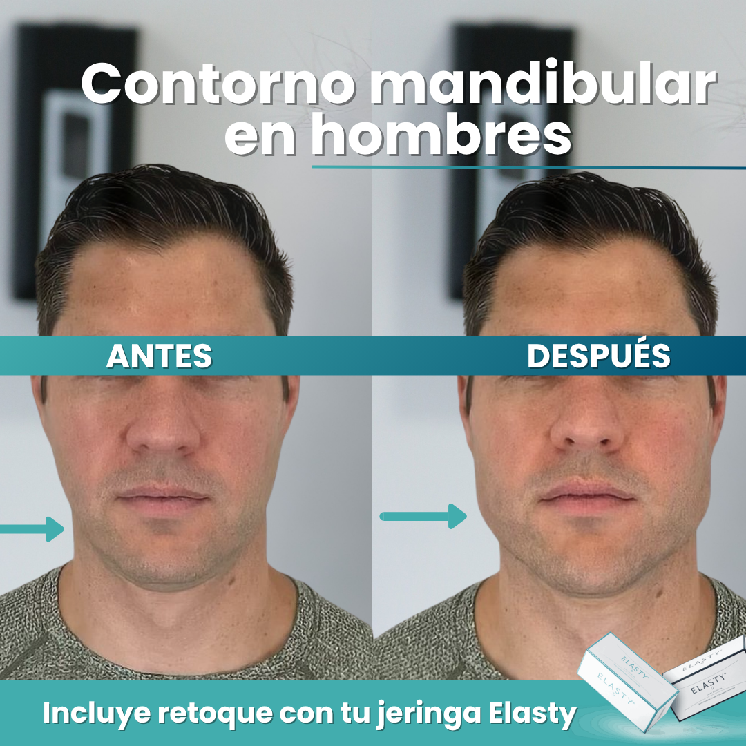 Contorno Mandibular con Ácido Hialurónico | Perfil Facial Definido