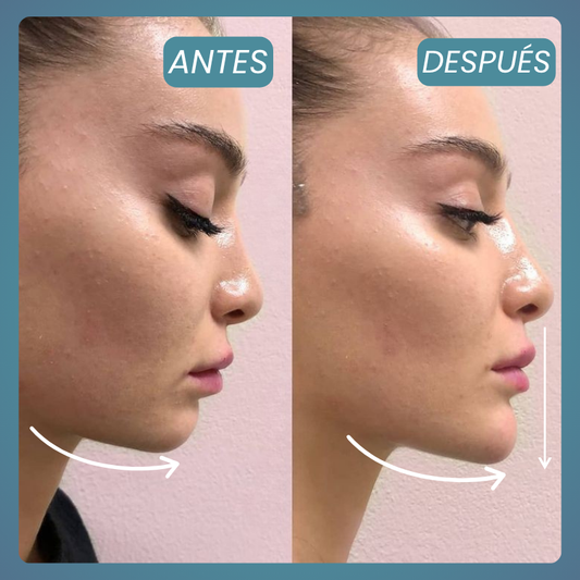 Definición y Armonización del Mentón – 1 Zona (Ácido Hialurónico)