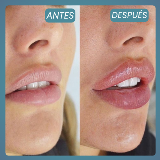 Aumento Labial Armónico – 1 Zona (Ácido Hialurónico)