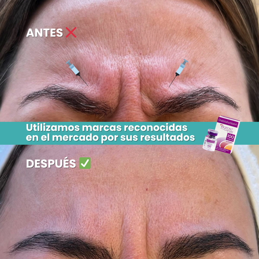 Botox Facial 3 Zonas | Corrección de Arrugas y Líneas de Expresión