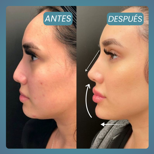 Armonización Facial Integral 3 Zonas (3ml)