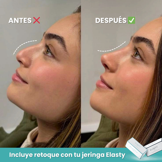Rinomodelación Nasal sin Cirugía | Ácido Hialurónico