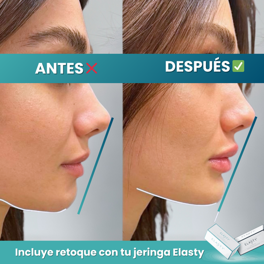 Rinomodelación y Aumento Labial con Ácido Hialurónico